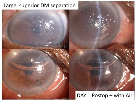 Ten Pearls For Descemet S Membrane Detachment Repair