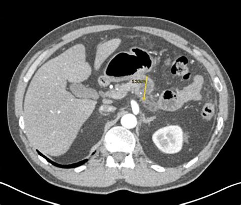 Incidental Neuroendocrine Tumor Pancreas In Patient With Distal