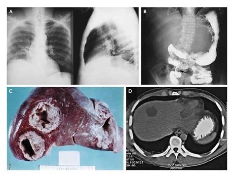 Amebiasis Extraintestinal