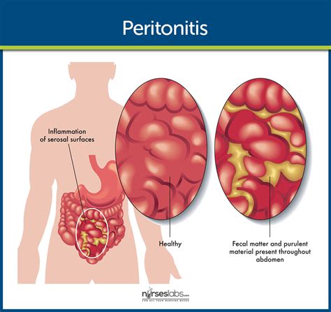 Peritonitis Pathophysiology Nursing School Success Nursing School