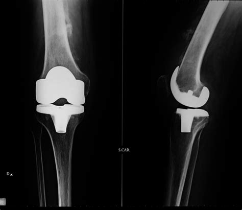 Presence Of Grade Iii Heterotopic Ossification Anterior To The Distal Download Scientific