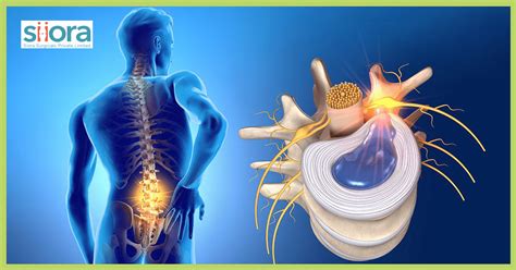 Thoracic Disc Herniation A Quick Guide Health Ortho