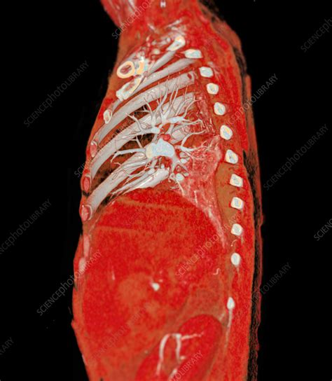 Pulmonary artery, CT scan - Stock Image - F037/7295 - Science Photo Library