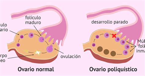 Sindrome De Ovario Poliquistico Diagnostico