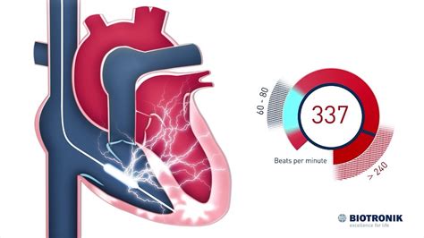 Desfibrilador cardioversor implantable Cómo funciona YouTube