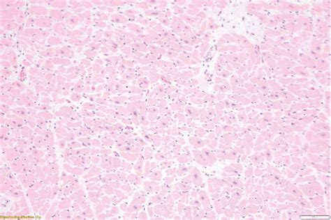 Myocyte Hypertrophy In The Heart A And Hyaline Arteriolosclerosis