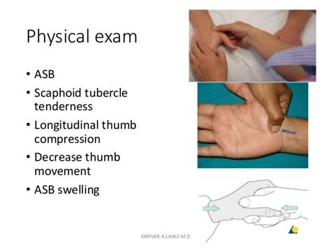 Scaphoid fracture