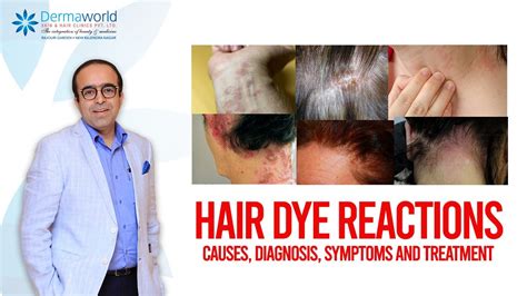 Hair Dye Reactions Causes Diagnosis Symptoms And Treatment Youtube