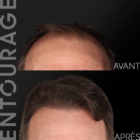 Greffe de cheveux à Lausanne Prix des implants capillaires