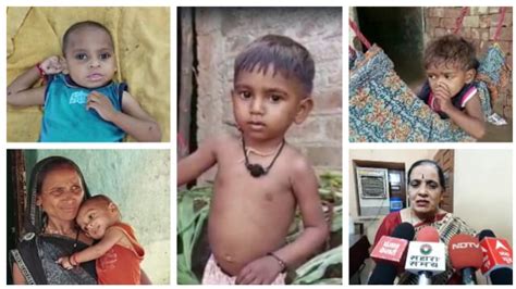 Reality Of Malnourished Children In Madhya Pradesh Survey Does Not