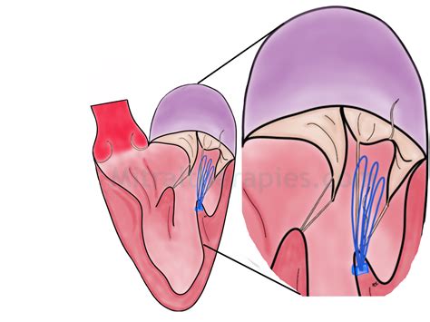 MITRAL VALVE REPAIR — Mitral Therapies.com