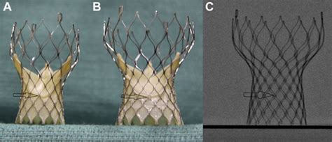 Fluoroscopic Guide To An Ideal Implant Position For Sapien XT And