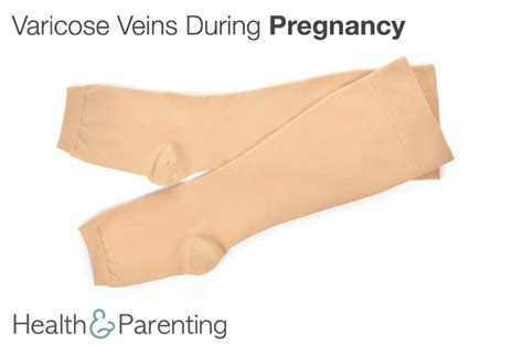 Varicose Veins During Pregnancy - Health & Parenting