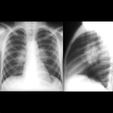 Pediatric Tuberculosis Pneumonia Pediatric Radiology Reference Article Pediatric Imaging