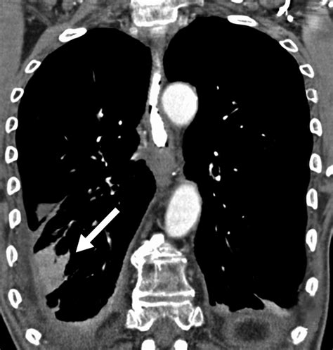 Solid Pleural Lesions Ajr