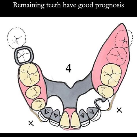 Universal Scandinavian partial denture designs | Finlay Sutton - Denture Education