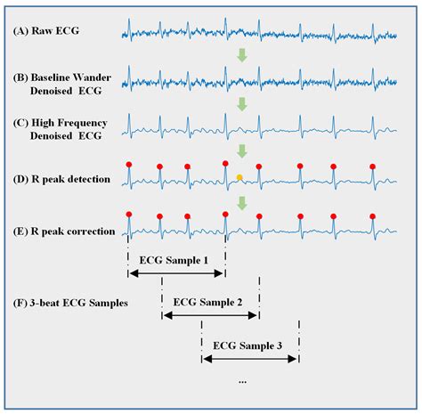 Jpm Free Full Text Detection Of Paroxysmal Atrial Fibrillation From Dynamic Ecg Recordings