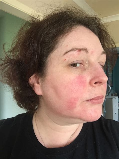 Malar Rash Red Butterfly Over The Bridge Hashimotos Disease