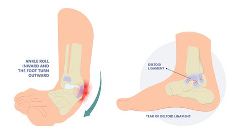 How to Heal a Torn Deltoid Ligament - Regenexx