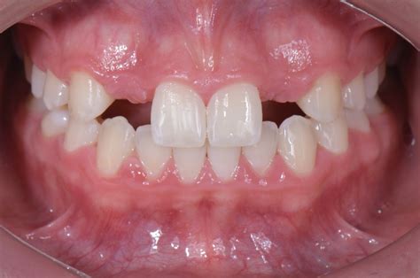 Three Solutions For Congenitally Missing Lateral Incisors Spear Education