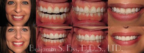 Porcelain Veneers In Chicago Il Chicago Benjamin S Fiss D D S