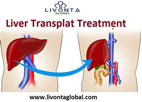 Liver Transplant Treatment Liver Transplant Is A Procedure Flickr