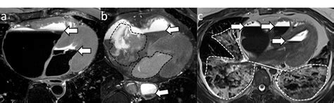 Figure 1 From Essentials Of Forensic Post Mortem MR Imaging In Adults