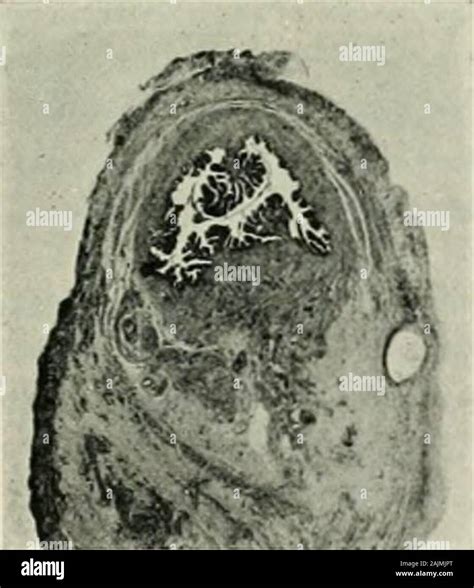 Acute Salpingitis Hi Res Stock Photography And Images Alamy