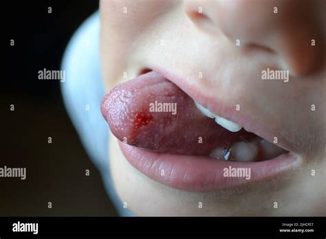 Bitten tongue hi-res stock photography and images - Alamy