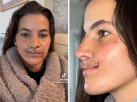 Brooklinn Khoury Shows Off Results Of Latest Lip Reconstruction Surgery