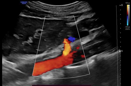 Median arcuate ligament syndrome (Dunbar syndrome) | Radiology Case ...