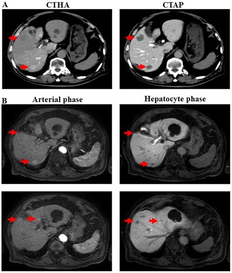 Primary Hepatic Neuroendocrine Tumor A Case Report