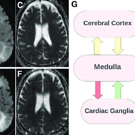 A Mri T2 Flair B Diffusion Weighted Imaging Dwi Sequence And C Download Scientific