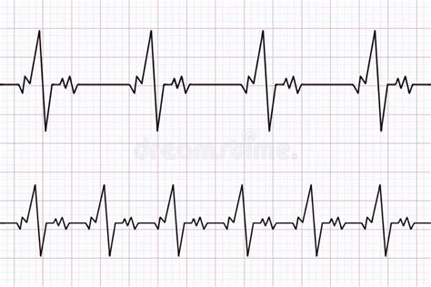 Electrocardiogram Paper With Normal Ecg Stock Vector Illustration Of Potential Heartbeat