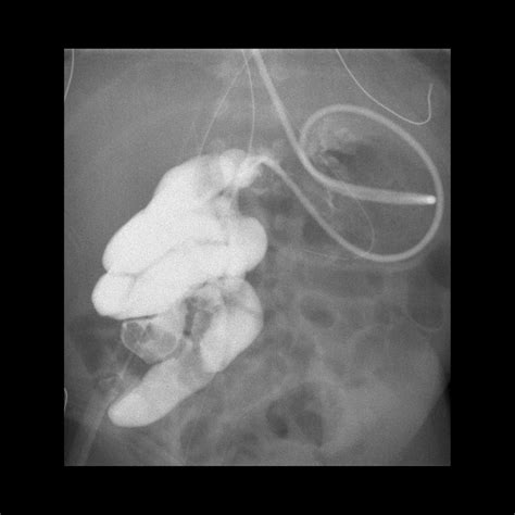 Ligament Of Treitz Malrotation