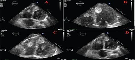 Transthoracic Echocardiography Apical 4 Chamber Views And Multiple