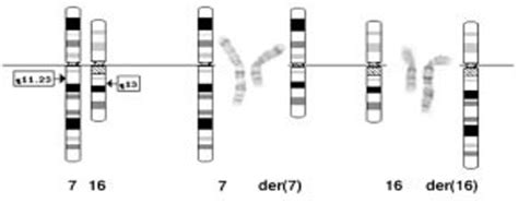 Williams Beuren Syndrome Nextgen Hospitals