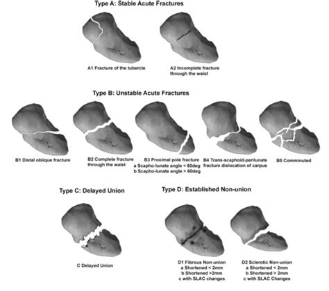 Scaphoid Fractures Classification Signs Geeky Medics