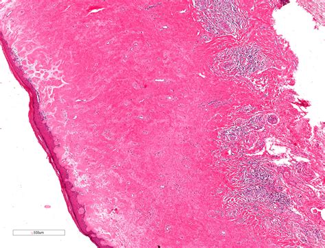 Balanitis Xerotica Obliterans Histology