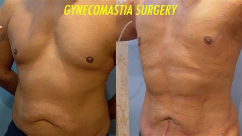 Gynecomastia 18 Hrs Post Op‼️ Vaser Hi Def Lipo Gland Out Renuvion Fat Grafting💪🏼dr