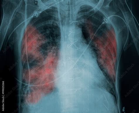 X-ray picture of a patient with lung pathology Stock Photo | Adobe Stock