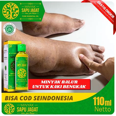 Jual Minyak Balur Untuk Kaki Bengkak Karena Jantung Ginjal Asam Urat