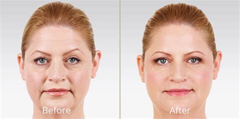 Juvéderm Dermal Fillers Skin Care Institute Tulsa Ok