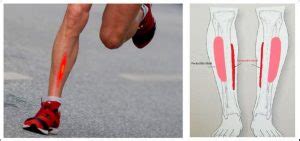 El Running Y La Periostitis Tibial Lo Que Debes Saber Helse