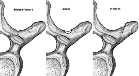 The Three Techniques To Start Thoracic Pedicle Screw Placement Download Scientific Diagram