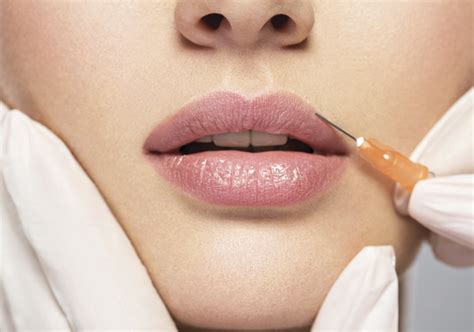 Preenchimento Labial Clínica De Estética Esmerar