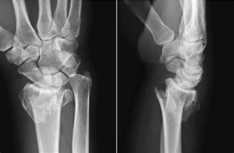 Posteroanterior And Lateral Radiographs Of The Affected Wrist Showing