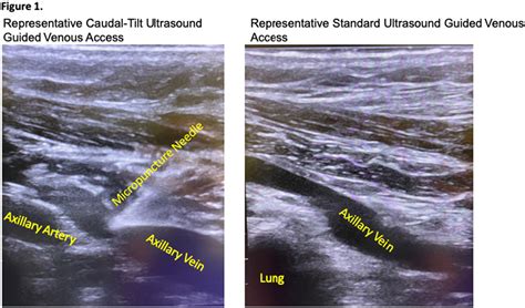 Po Caudal Tilt Ultrasound Guided Axillary Venous Access For