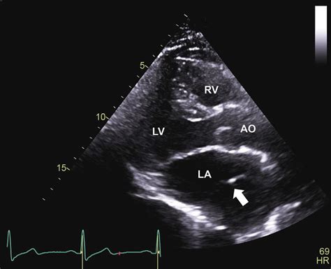 Two Dimensional Parasternal Long Axis View Of Linear Echodensity In