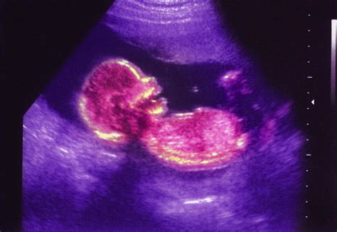 foetus photograph  josh sher science photo library pixels
